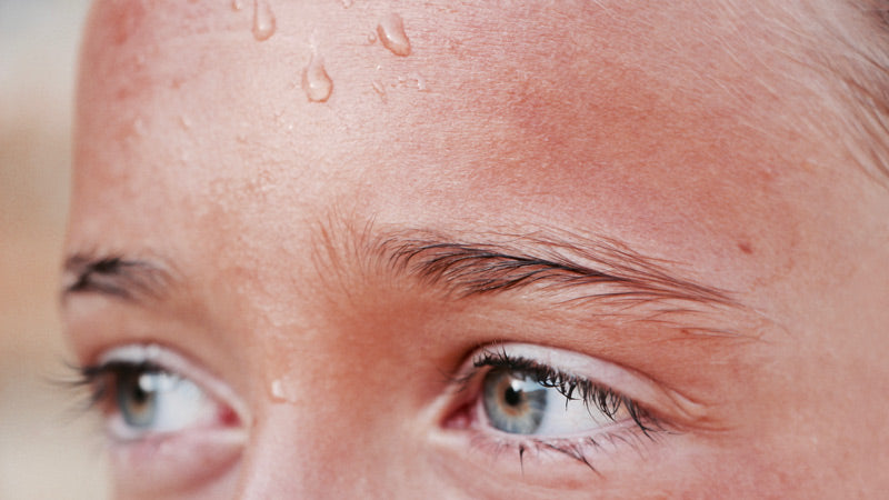 Is Hyperhidrosis Serious?